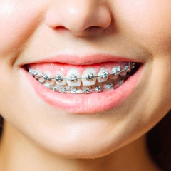 img-trmnt-braces-metal