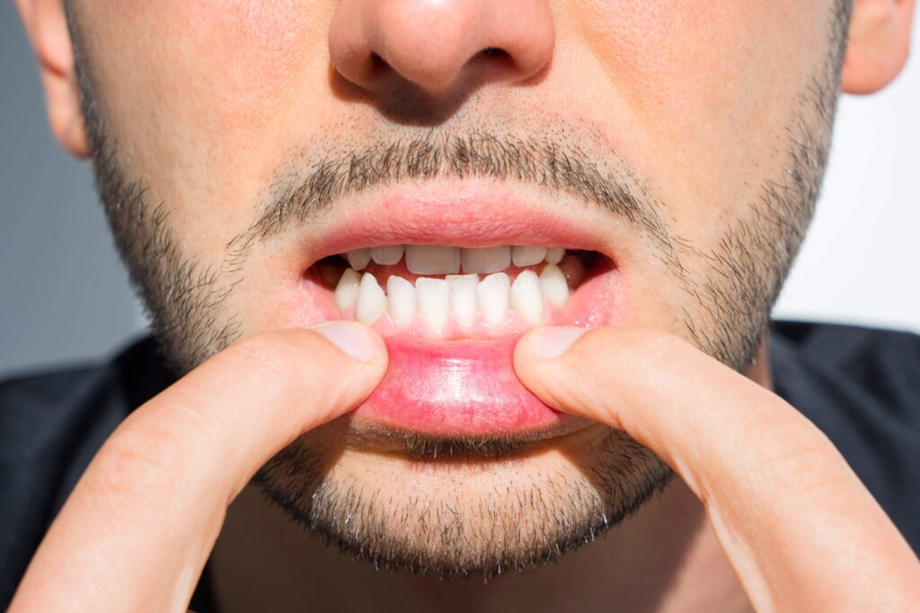How Braces Can Help Correct an Underbite - Elassal Orthodontics
