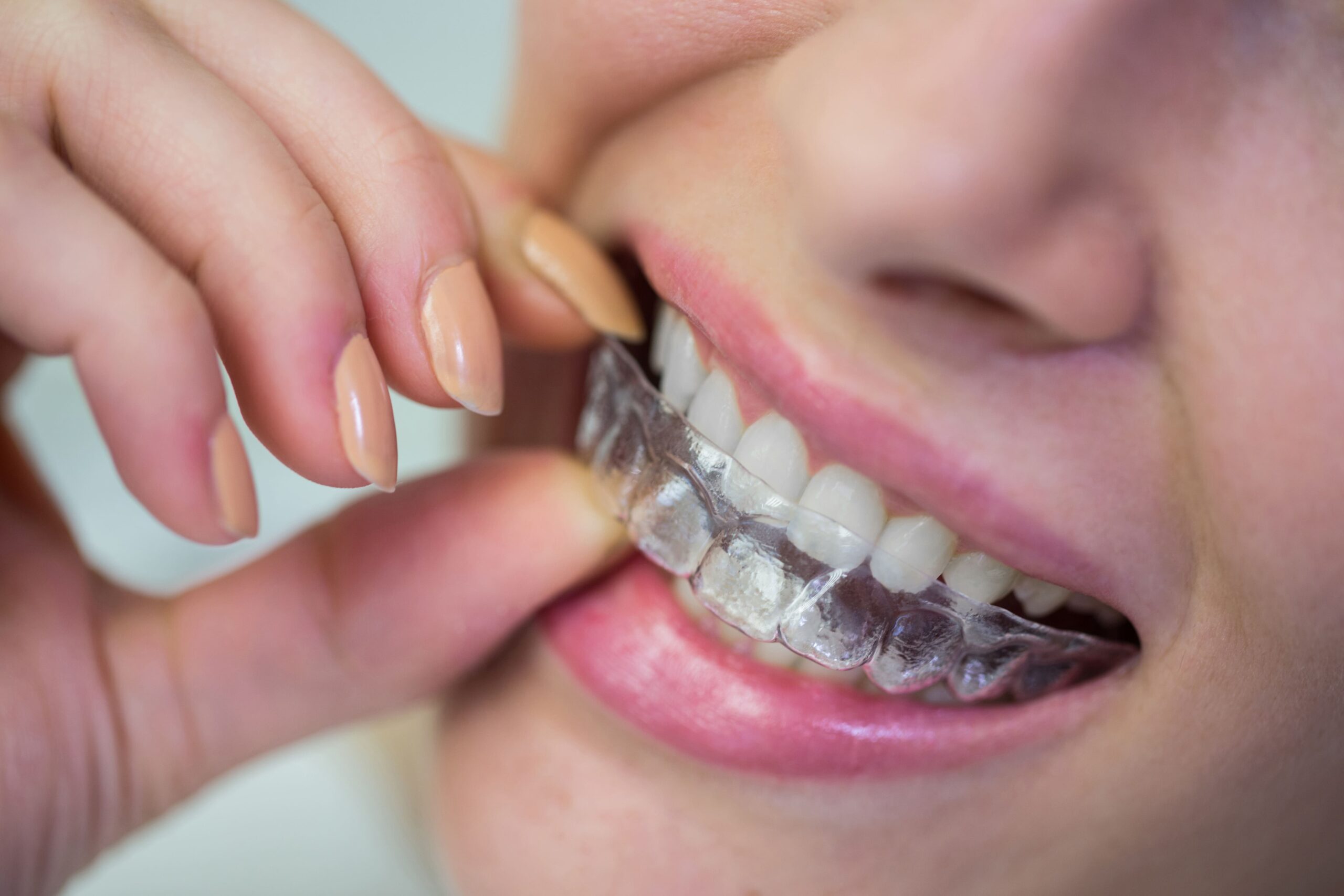 Invisalign treatment near oklahoma city