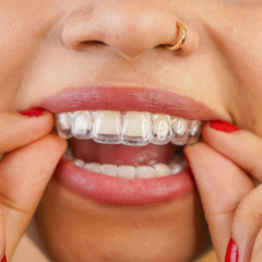 types-of-braces-invisalign